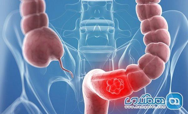 سرطان روده بزرگ؛ سومین سرطان شایع مردان و چهارمین در زنان ایرانی