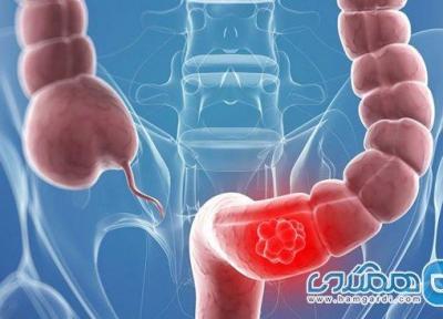 سرطان روده بزرگ؛ سومین سرطان شایع مردان و چهارمین در زنان ایرانی