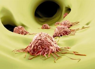 پیشگیری از متاستاز تومور با به خواب بردن سلول های سرطانی!