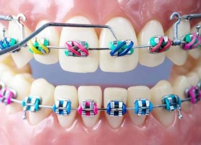 روش های درمان دندان های کج
