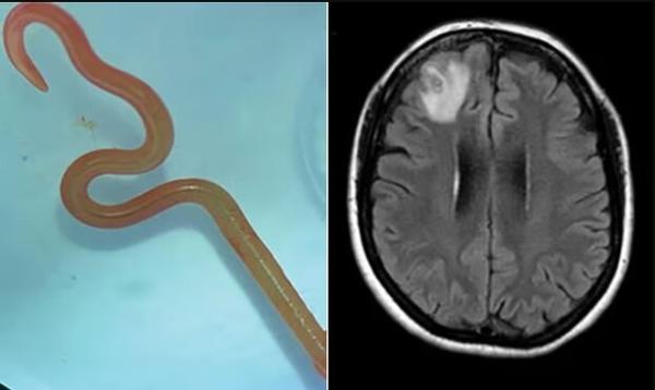 عکس ، کشف بی سابقه کرم زنده در مغز یک بیمار ، مارهای پیتون میزبان این انگل هستند